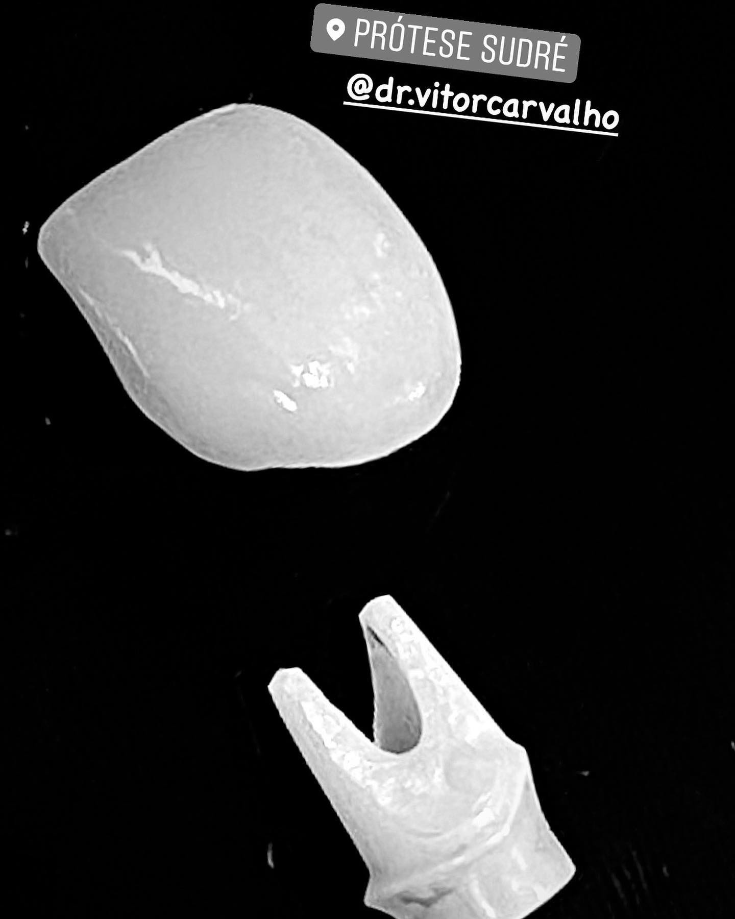 Implantes: Coroas, Pontes e Munhões Personalizados