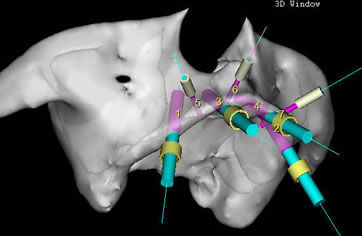 Implantes Sem Cortes? Saiba Mais
