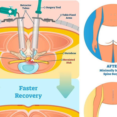 Minimally Invasive Spine Surgery vs Traditional Spine Surgery: A Comparative Guide