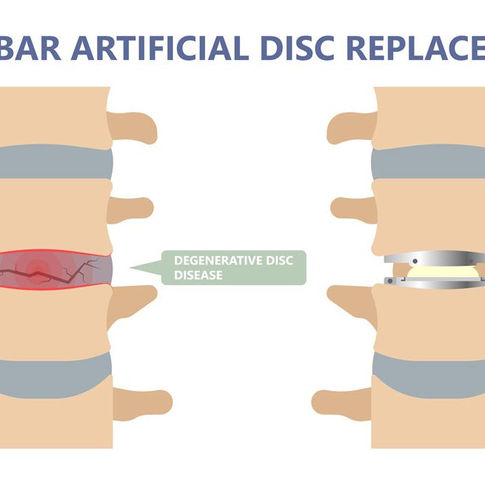 Spinal Fusion vs Disc Replacement: When to Consider Each