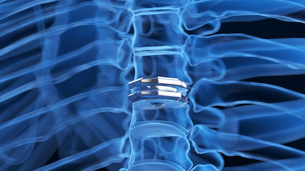 Cervical-disc-replacement x-ray