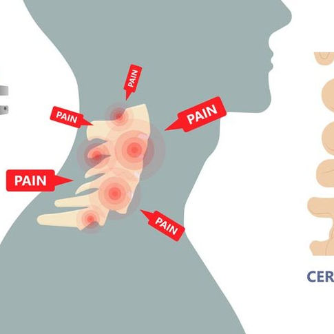 Key Points to Understand About Cervical Artificial Disc Replacement