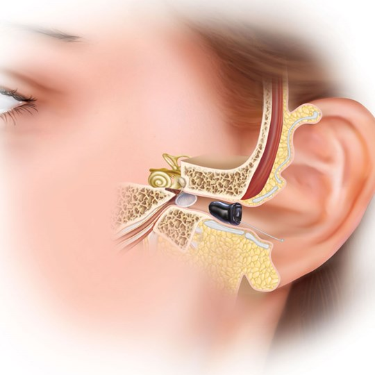 Chuyên Gia Thính Lực Nói Gì Về Máy Trợ Thính?