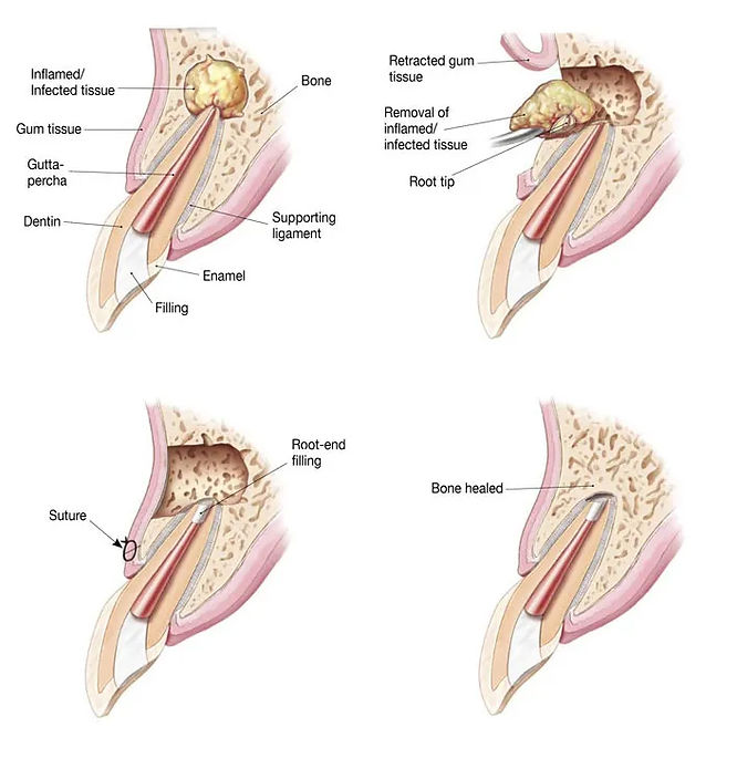 apical surgery