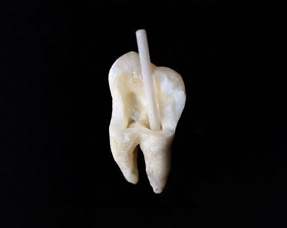 dental posts