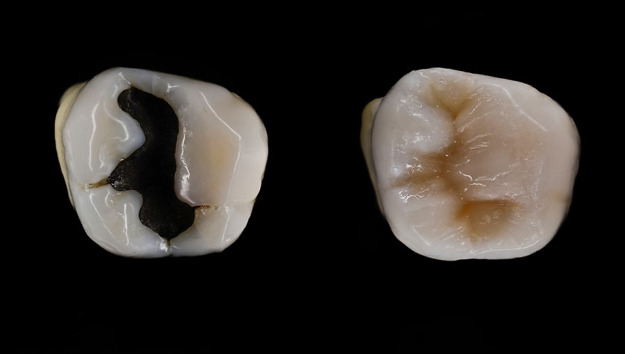 Composite filling