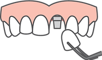 Dental implants diagram