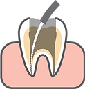 Root Canal Treatment diagram