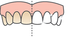 Tooth Whitening diagram
