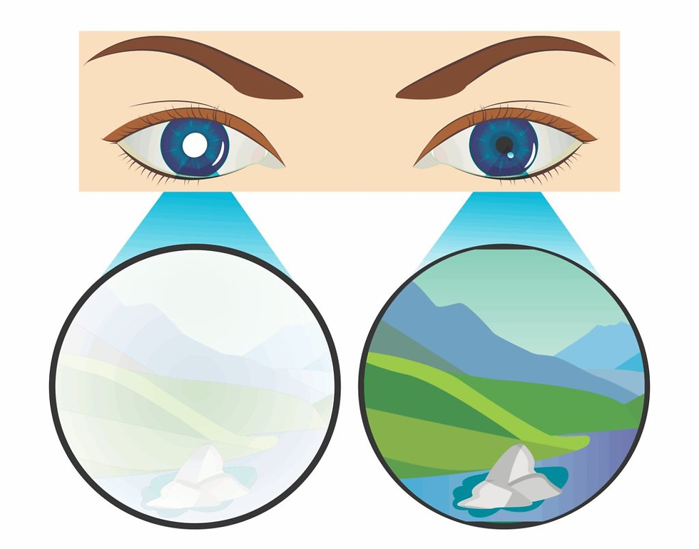 Nhược thị và điều trị nhược thị