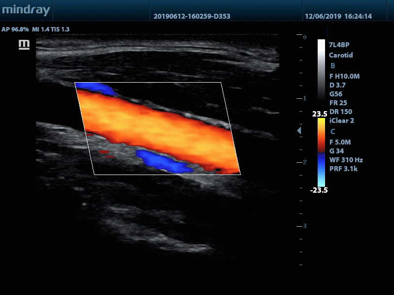 7L4BP-carotid-color_1.gif