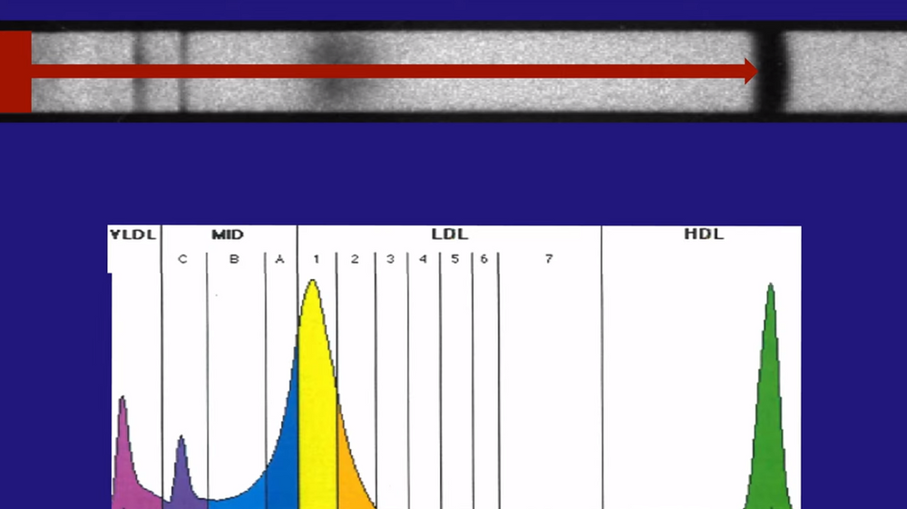 Does LDL Particle Size Really Matter?