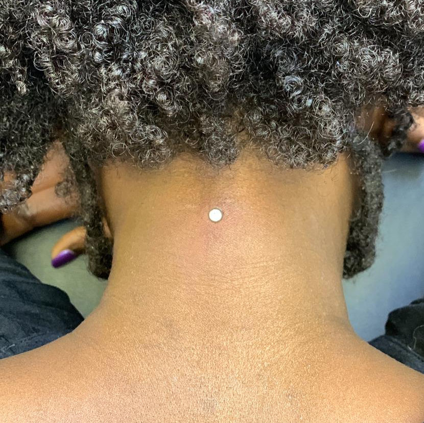 microdermal nuque