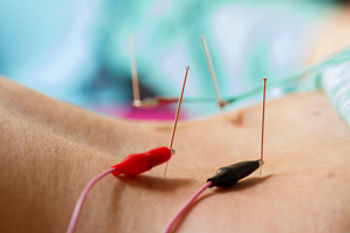 Electro-acupuncture in Buxton, High Peak