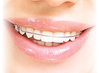 aparelhos ortodonticos1.png