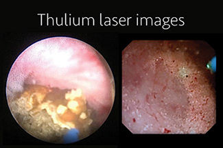 URETEROSCOPIA CON LITOTRICIA CON LASER DE TULIO PARA PIEDRA EN EL RIÑON