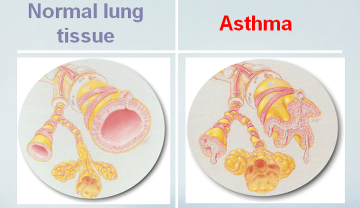Asthmatic-Airways