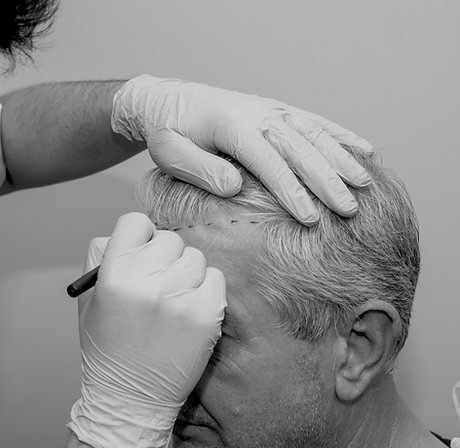 Transplante Capilar Dr Raphel Garcia Belo Horizonte