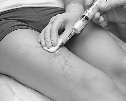 20251216_1451_Escleroterapia com Espuma_simple_compose_01kcm4gm3mf7b828ngvay4a107.png