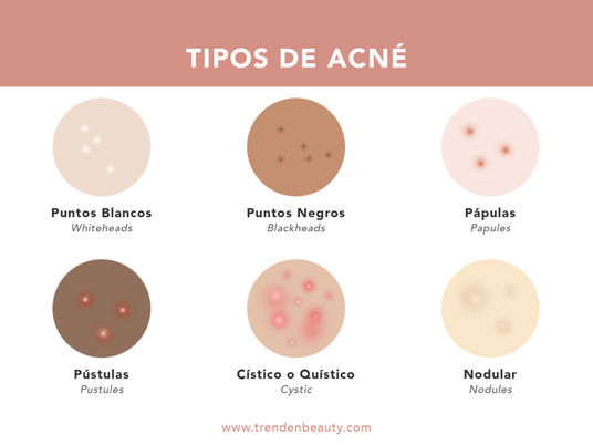 Tipos de acné en la cara y cómo reconocerlos