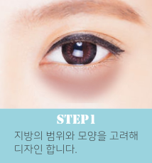 눈밑지방재배치수술방법1.png