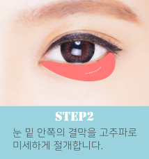 눈밑지방재배치수술방법2.png
