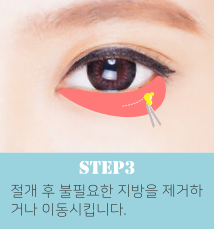 눈밑지방재배치수술방법3.png