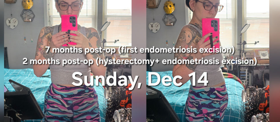 Hysterectomy Recovery: 2 Months