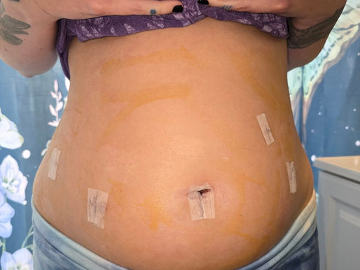 Endo Excision: Day 4