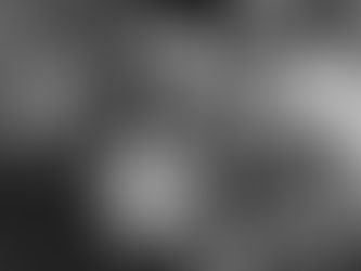 Endo Excision: Day 133 (4.5 months after first surgery)