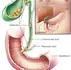Gallbladder Stone Treatments