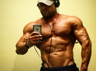 Post Finasteride Syndrome