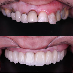 Protese Protocolo Ceramica 