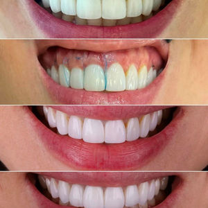 Enxerto Tecido Conjuntivo 