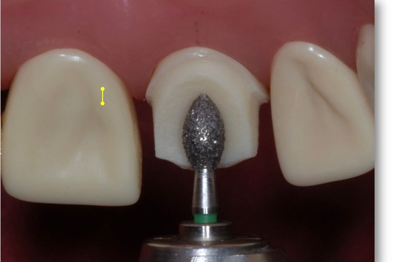 Crown Preparation Guidelines for Dental Bench Tests & Equivalency : PFM vs All-Porcelain vs Zirconia