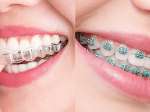 Invisalign vs. Traditional Braces: What's the Best Option for You?