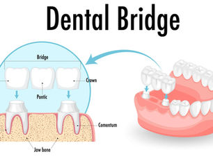 DENTAL BRIDGE:  CAN FIX A GAP IN TEETH