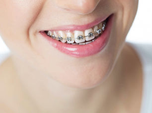 Conventional Orthodontics: Its Benefits And Types