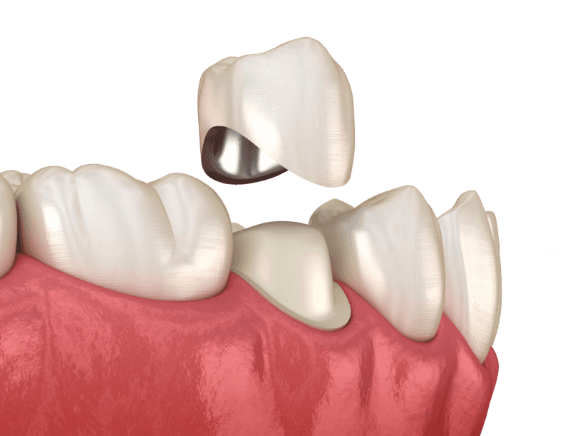 dentures-2.jpg