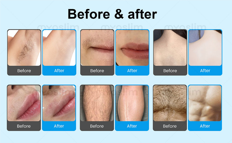 Thumbnail: 10 Bars FAC 5000W Soprano Diode Laser Hair Removal 4 Waves 755 940 1064 808nm CE