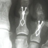 Smart Toe Spange