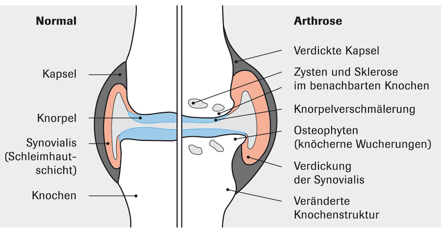 Arthrosen