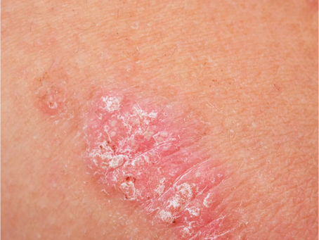 Can Goat’s Milk or Tallow "Treat" or "Cure" Psoriasis, Eczema, or Rosacea?