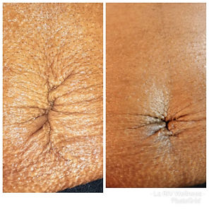 microneedle treatment 5.jpg