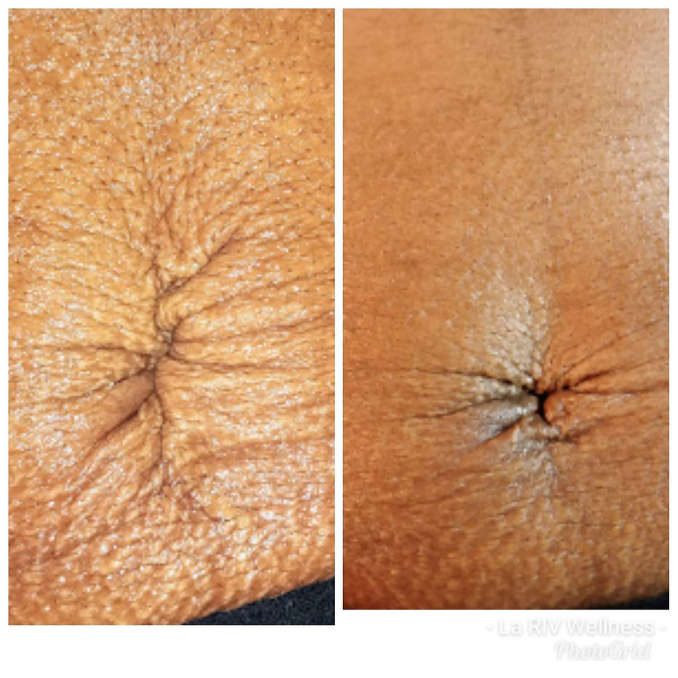 Microneedle 4 treatment