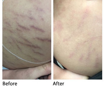 eclipseaesthetics.com stretch marks.jpg