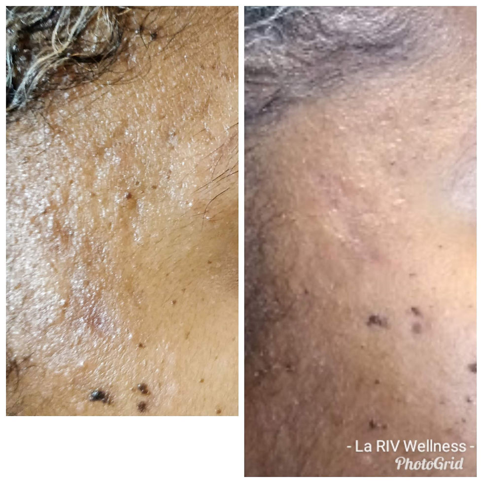 Microneedle 1 treatment