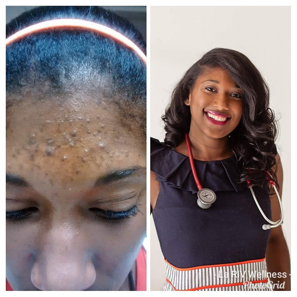 Severe Acne