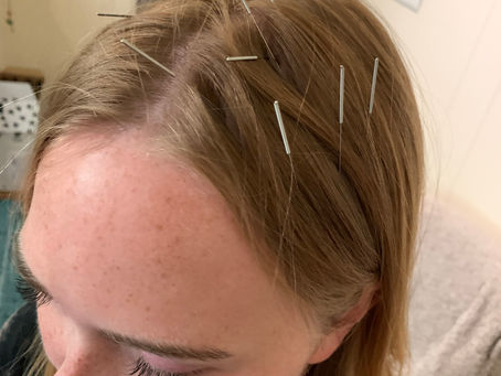 Neuro-Acupuncture 