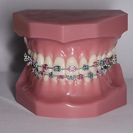 Fixní aparáty jsou pevně nalepeny na zuby po celou dobu léčby. Nelze je sejmout.